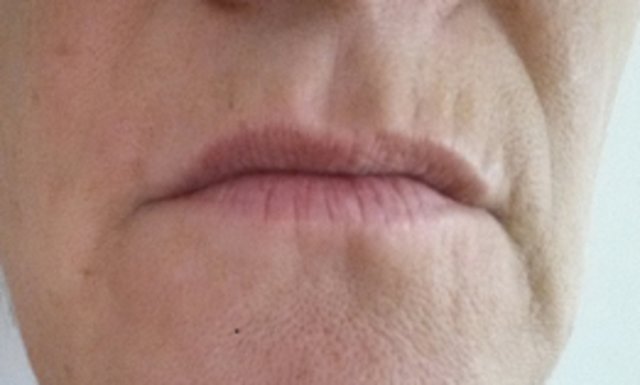 Vor der Behandlung mit der Genesys Lifting Mask