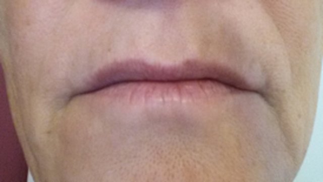 Nach der Behandlung mit der Genesys Lifting Mask – deutliche Faltenreduzierung