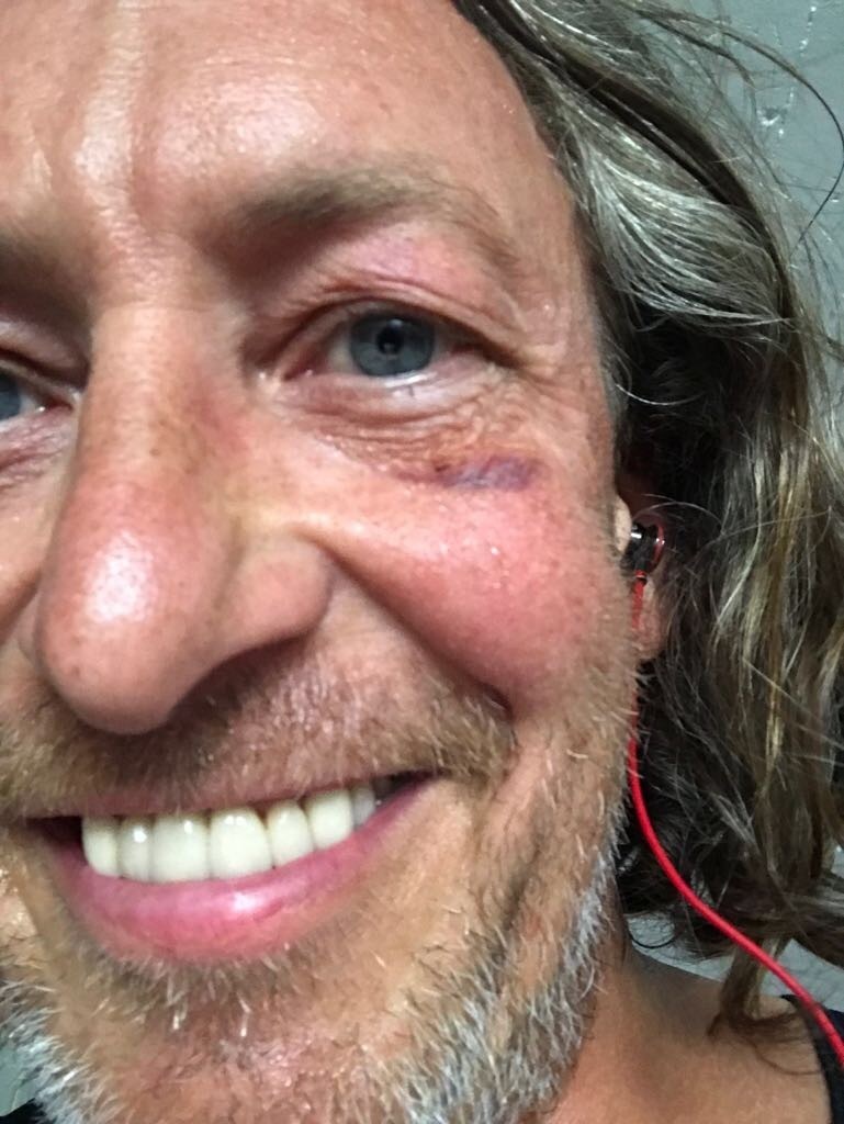 Ein prächtiges Veilchen blüht im Gesicht von Thomas Förster. Foto: © Privat